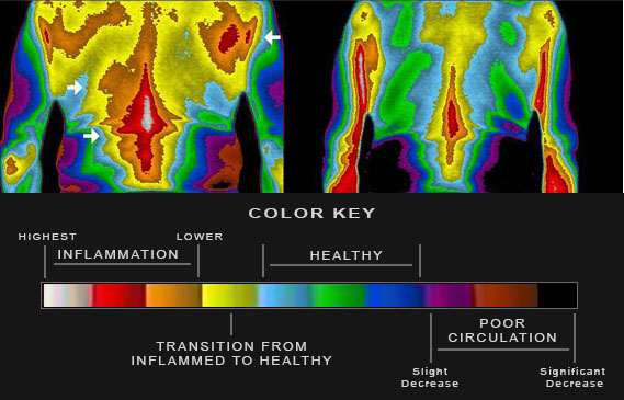 Medical infrared thermography from Dr. William Amalu's grounding case studies: before and after images of mid-back and shoulders showing dramatic reduction in inflammation after 4 nights of grounded sleep and after 30 minutes of grounded sleep