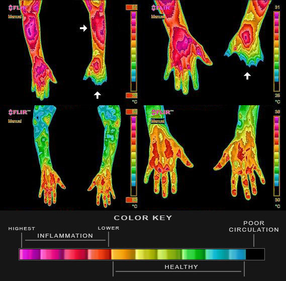 Medical infrared thermography: before and after grounding -- arms and hands showing inflammation reduction. Dr William Amalu case study 2004