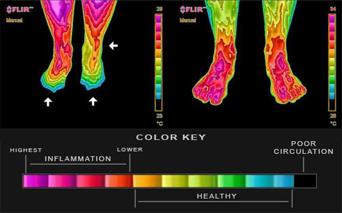 Infrared thermography legs and feet before and after grounding: dramatic reduction in inflammation and improved circulation after 4 nights sleeping grounded. Dr Amalu 2004