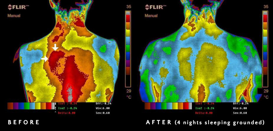 Medical thermography: before earthing shows high inflammation in red/orange heat patterns; after earthing shows normalised circulation in green/blue patterns. Chevalier et al. research.